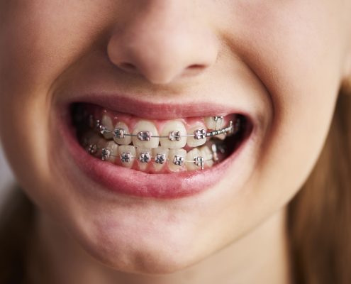 brackets de metal tradicionales