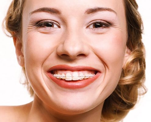 Brackets de zafiro precio