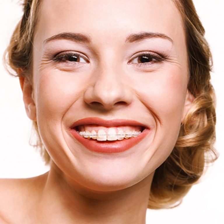 Brackets de zafiro precio