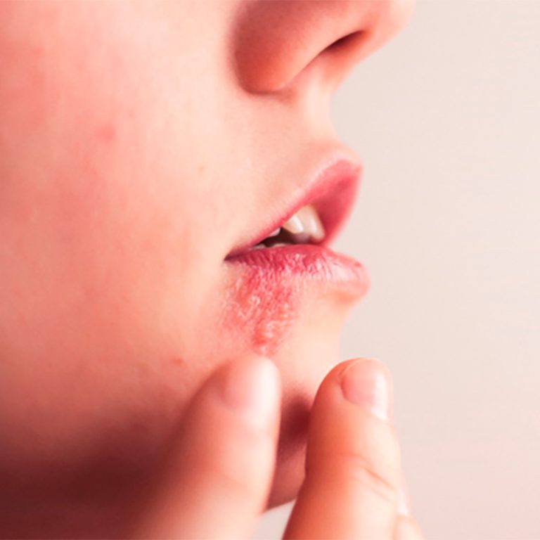 Gingivoestomatitis Herpética