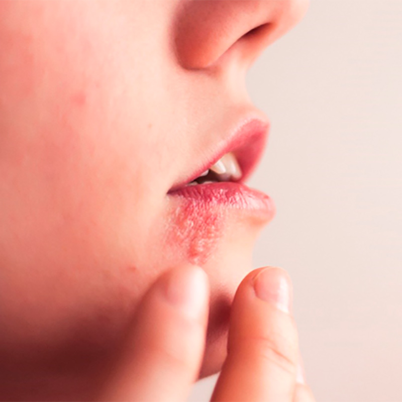 Gingivoestomatitis Herpética