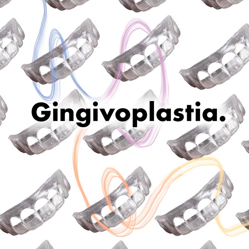 Consigue una sonrisa perfecta con la gingivoplastia