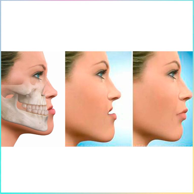 prognatismo mandibular