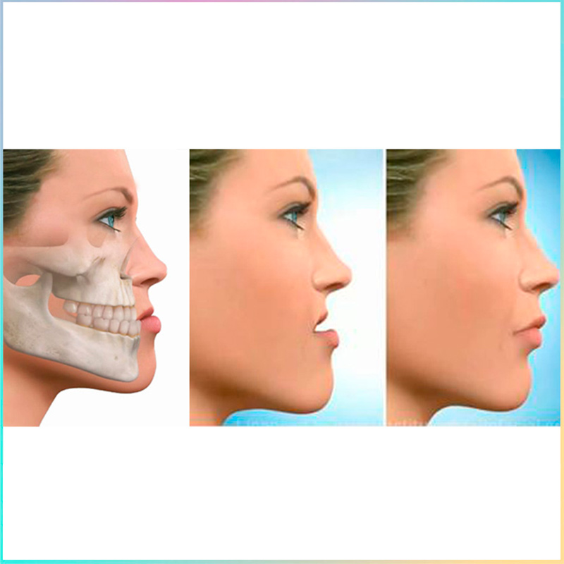 prognatismo mandibular