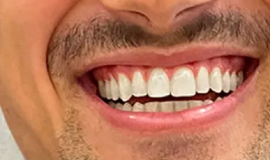 Sonrisa de un hombre tras haber recibido un tratamiento de blanqueamiento dental.