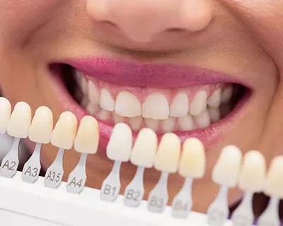 ¿Cuáles son mejores: las carillas dentales o las de porcelana?