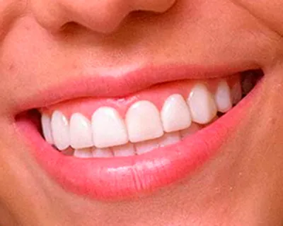 ¿Cómo cuidar las carillas dentales para que duren más tiempo?