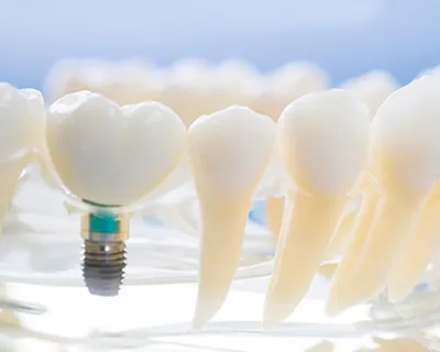¿Puedo llevar ortodoncia invisible con implantes dentales?