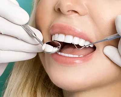 Precio Carillas Dentales en el 2023: Toda la información