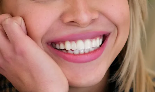 Sonrisa de una mujer después de haberse colocado carillas dentales de Smysecret.