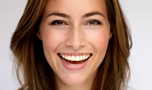 Carillas dentales de Smysecret.