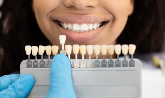 Tipos de carillas de composite.