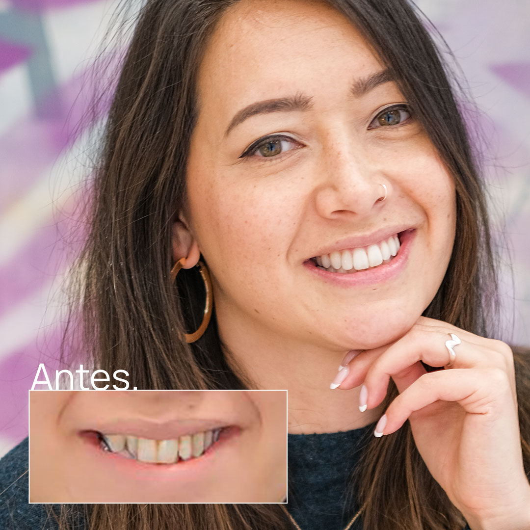 Ortodoncia invisible